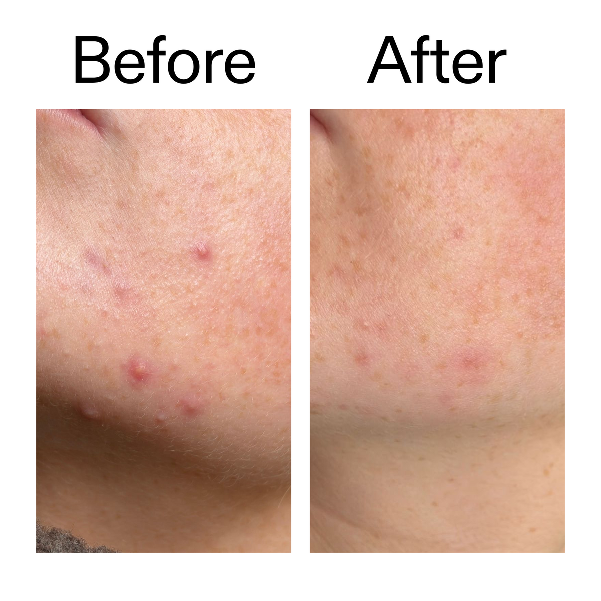 10-azelaic-acid-serum-for-redness-relief-n4 B_A_1_PPAGE.png