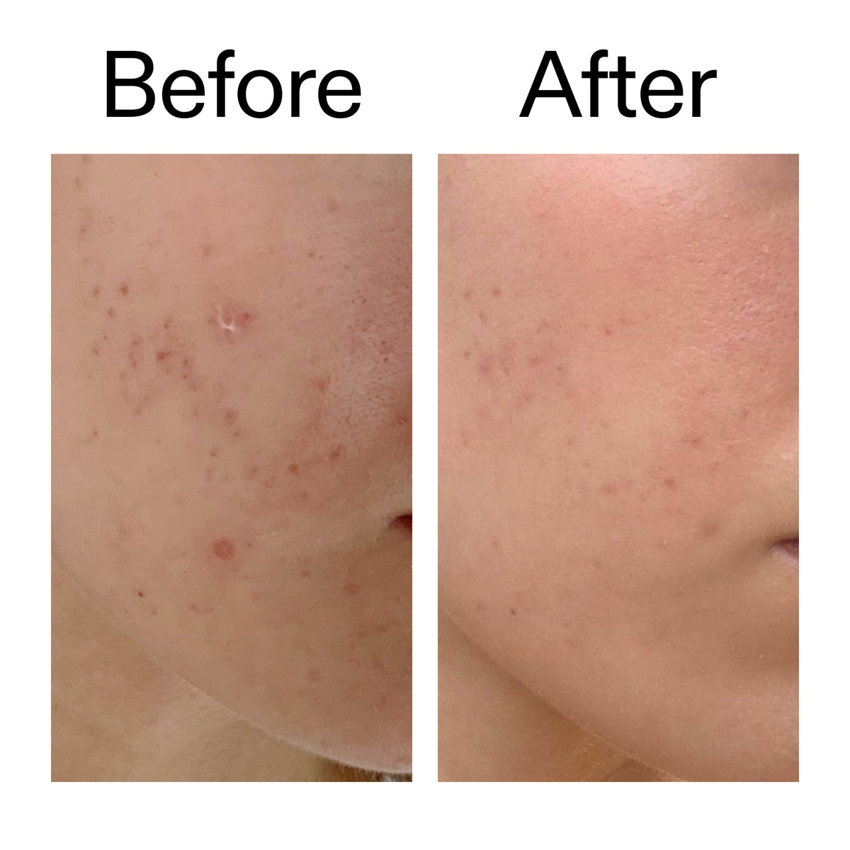 mandelic-acid-treatment-a9 Mandelic_Acid_Treatment_Before_After_2000x2000_4885ac6e-c5d7-4279-a72a-1417af7dce35.jpg