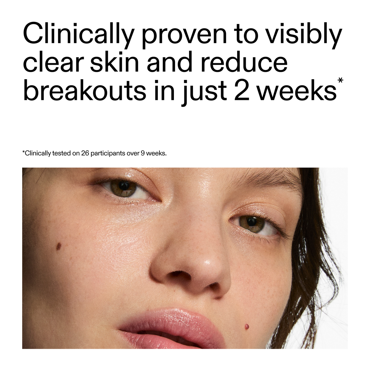 360-acne-clearing-serum-b4 360_Serum_Key_Claim.png