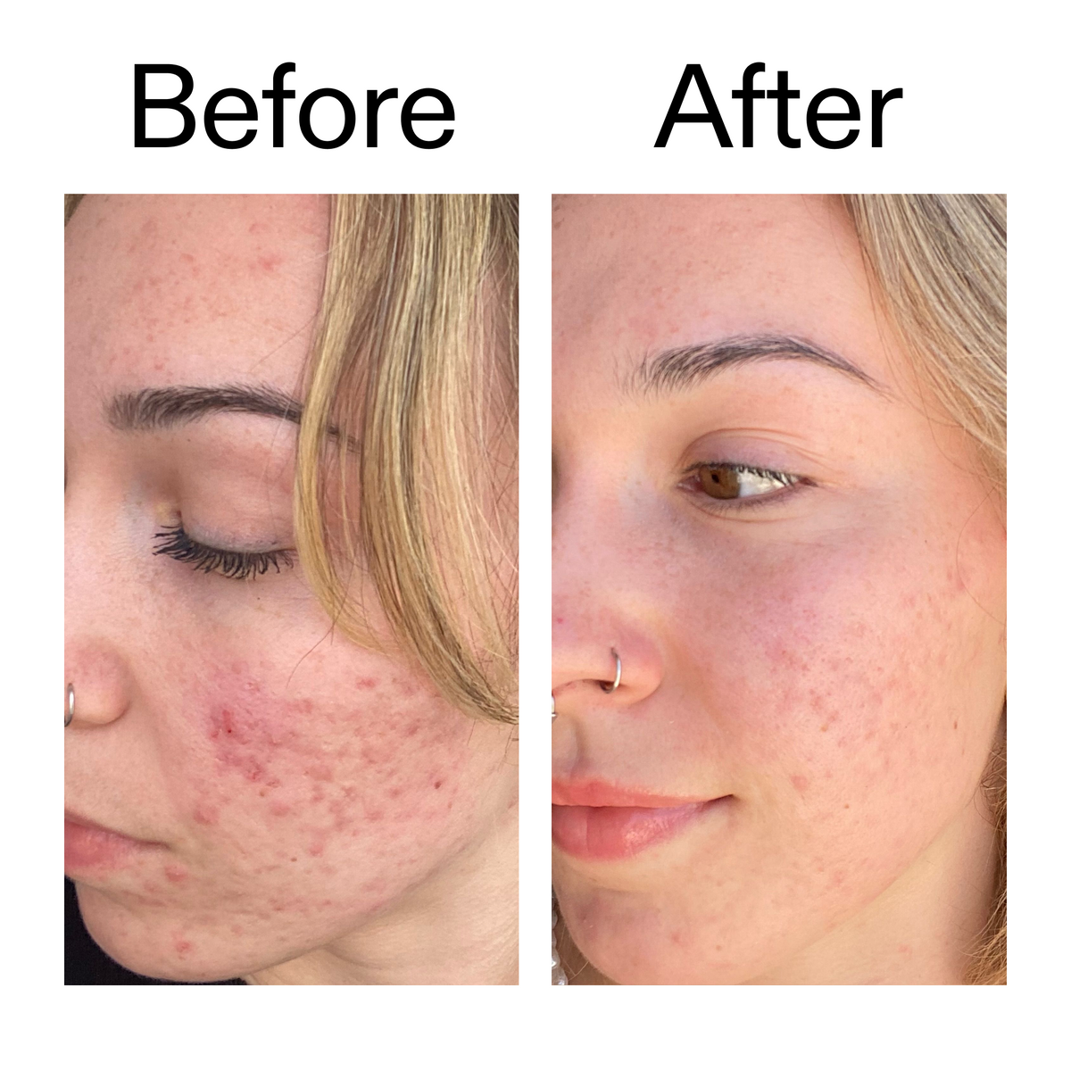 10-azelaic-acid-serum-for-redness-relief-n4 B_A_2_PPAGE.png