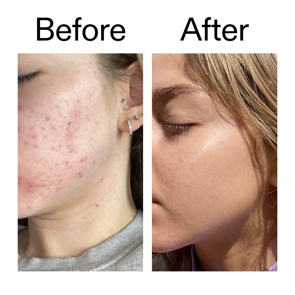 beta-hydroxy-acid-bha-serum-j8 Beta_Hydroxy_Acid_Serum_Before_After_2000x2000_96fda3e5-938d-49ef-bcf2-a0fa6ece4e2c.jpg