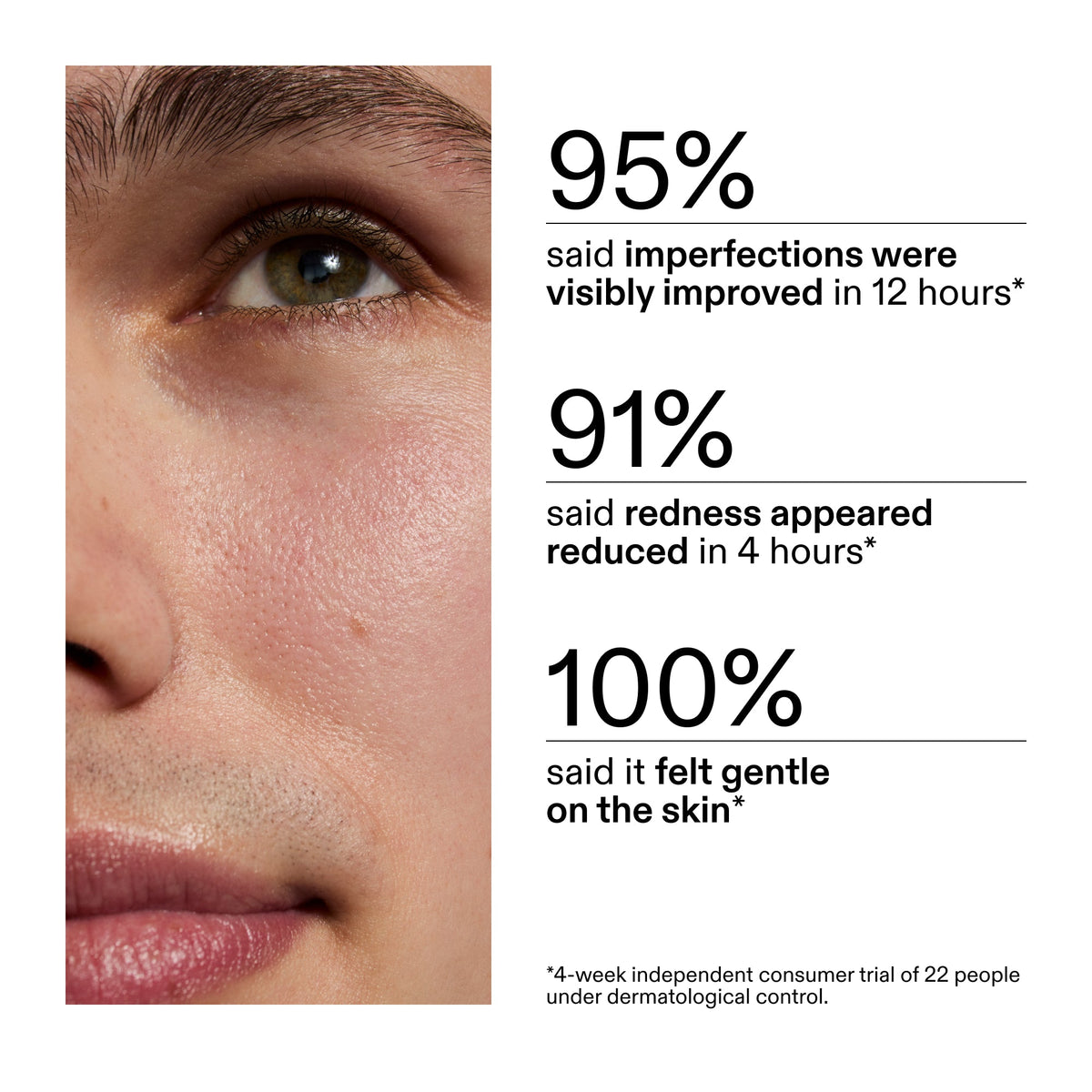 succinic-acid-acne-treatment-r4 CA_Succinic_Acid_Treatment_key_Claims_2000x2000_db91b0f1-7f29-4bfe-bb16-63a47f500960.jpg