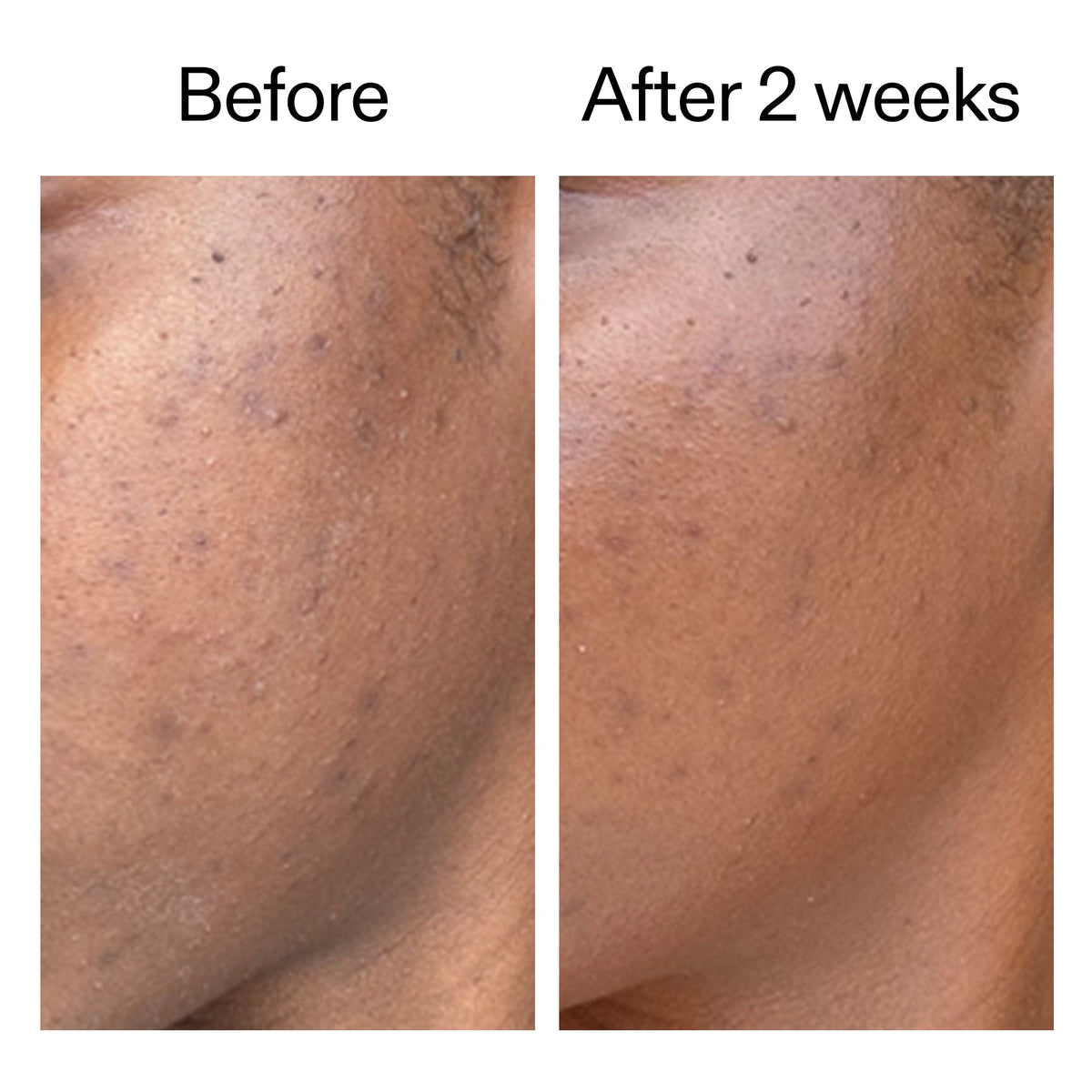 360-acne-clearing-duo-u2 DIOICB_A2000x2000.jpg