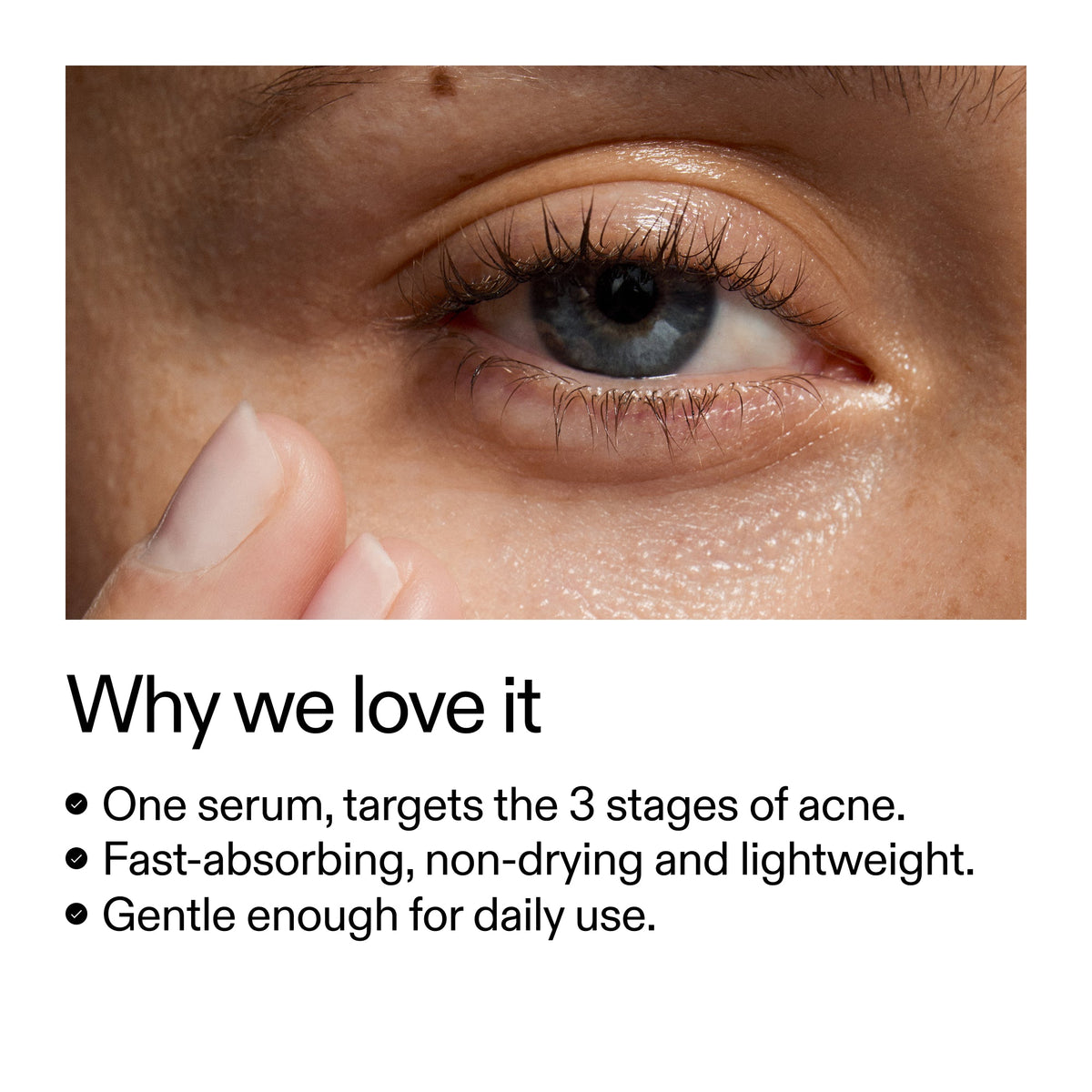 360-acne-clearing-duo-u2 Dioic_Whyweloveit_2000x2000_175aafd3-0cbe-403a-b317-a8362881bfe2.jpg
