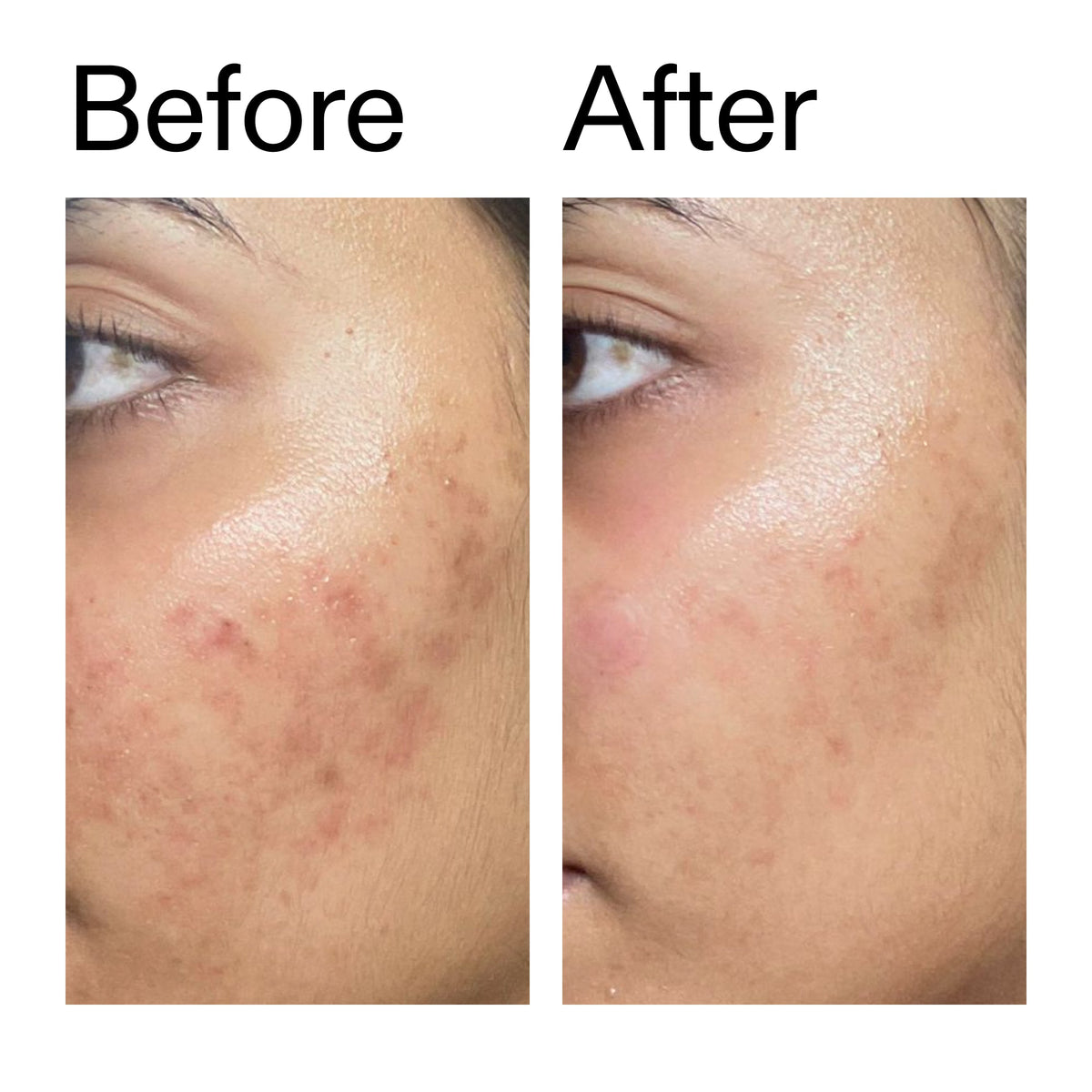 ectoin-hydro-barrier-serum-duo-q6 Ectoin_Hydro-barrier_Serum__Before_After_2000x2000_34261920-d004-48d0-9c7b-8e1c15971bfd.jpg
