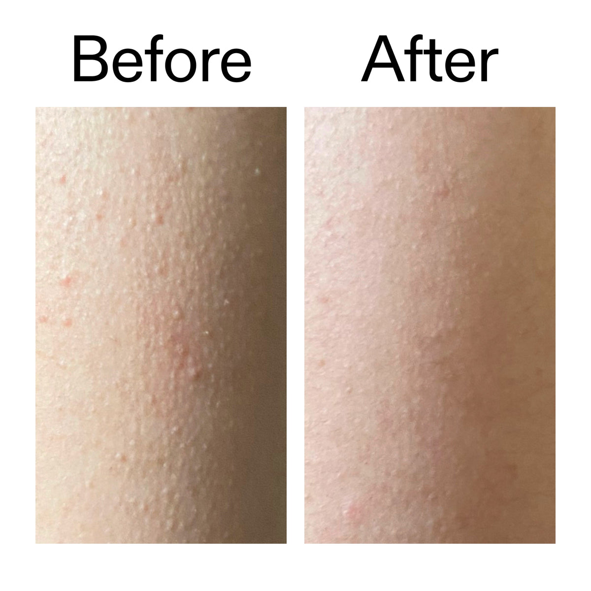 glycolic-acid-exfoliating-body-stick-b3 Glycolic_Acid_Exfoliating_Body_Stick_Before_After_V2_2000x2000_2e4ba052-94f6-4d56-82df-7bdb5b2df7ae.jpg
