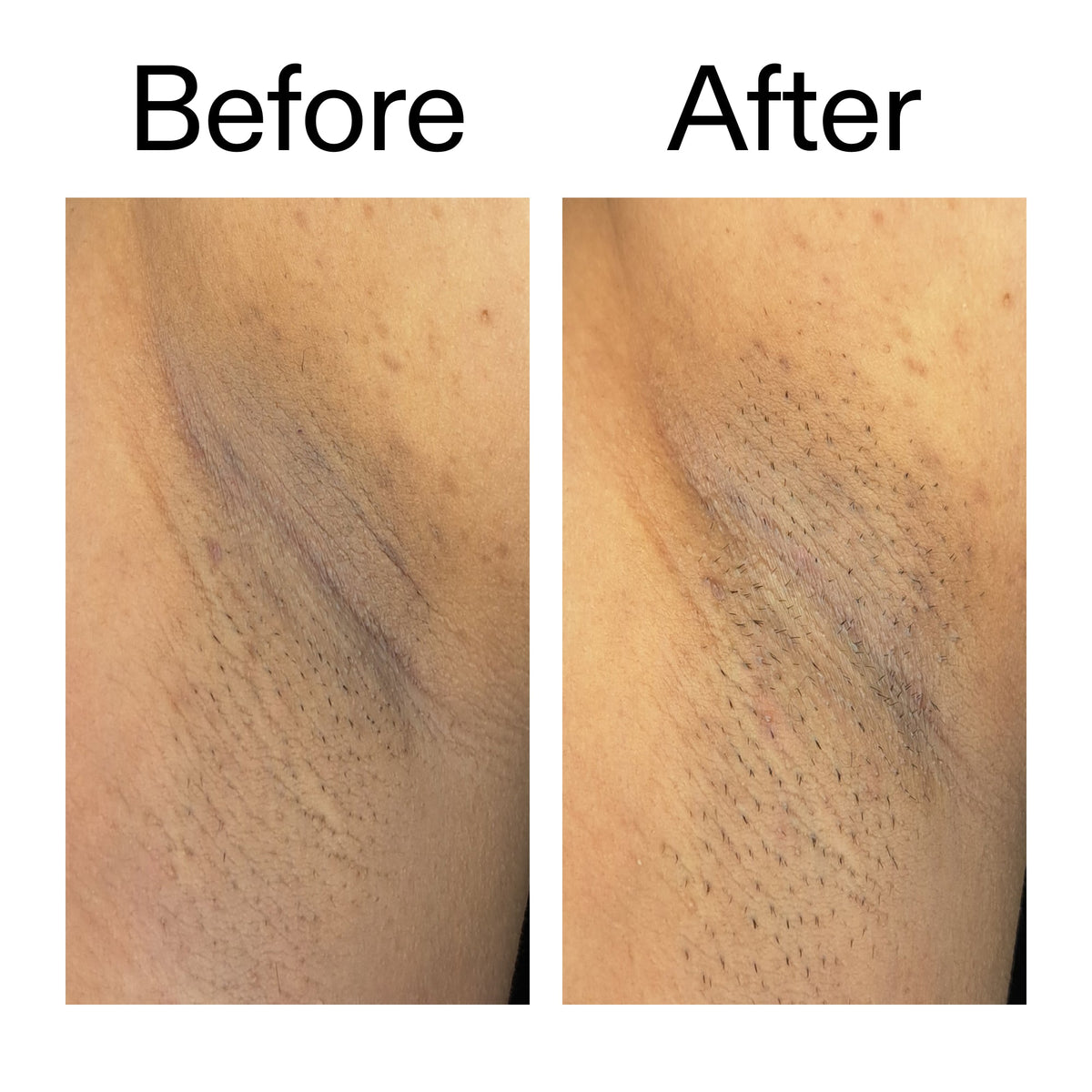 glycolic-acid-exfoliating-body-stick-b3 Glycolic_Acid_Exfoliating_Body_Stick_Before_After_V3_2000x2000_ea919cd9-1439-4a46-82a0-76200eb5bb42.jpg