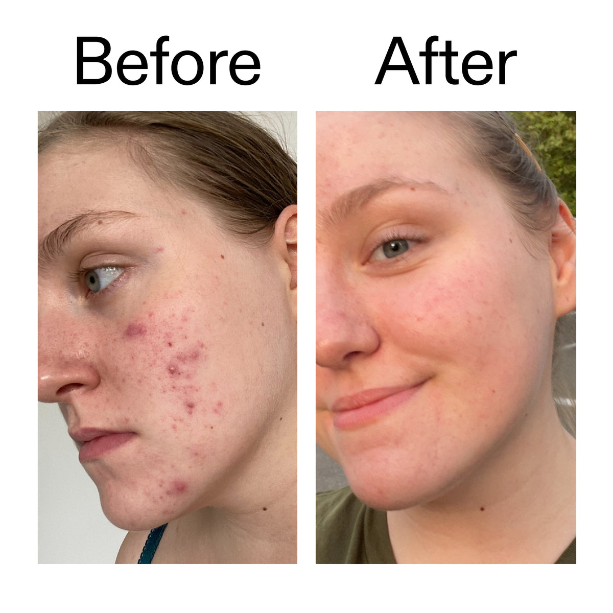 glycolic-acid-toner-i5 Glycolic_Acid_Toner_Before_After_2000x2000_49f0b9f7-e71b-4b2e-a8f8-2ea4b73247bb.jpg