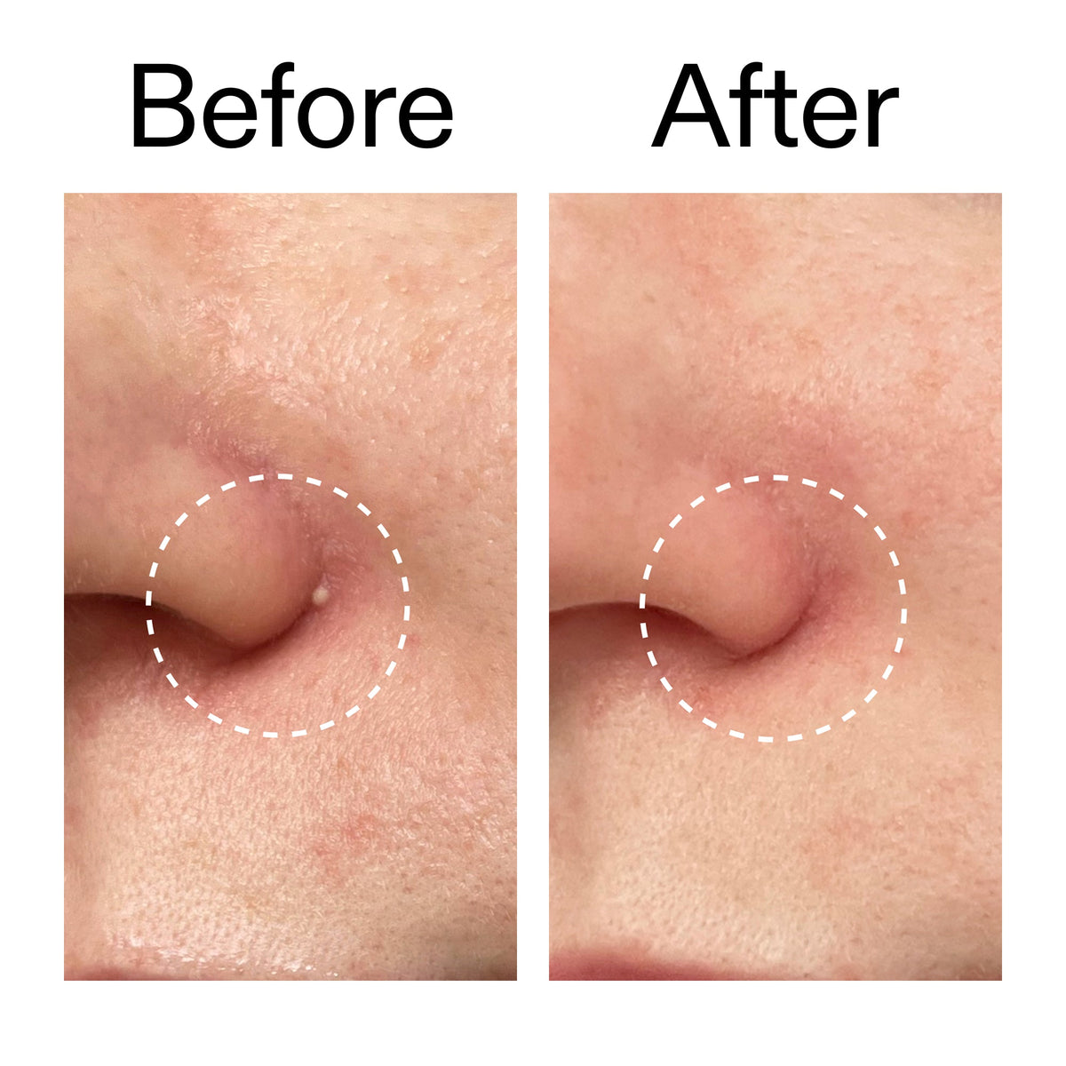 hydrocolloid-invisible-pimple-patches-pack-of-22-a5 Hydrocolloid_Invisible_Pimple_Patches_Before_After_2000x2000_b02aa37b-c78a-4682-91de-9135af5bb7df.jpg