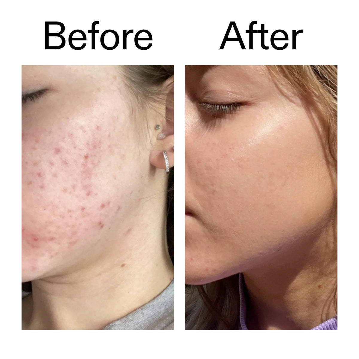 10-niacinamide-serum-duo-m0 Niacinamide_Serum_Before_After_2000x2000_bde32455-9e7d-448e-b053-bef41504f0a9.jpg
