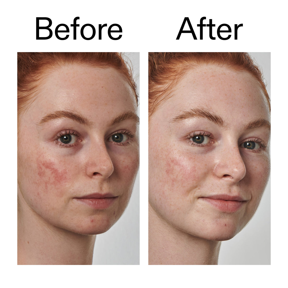 10-azelaic-acid-serum-for-redness-relief-n4 Redness_Relief_Serum_Before_After_2000x2000_3334dc9a-cce9-4e00-8aec-7ad89ca051f2.jpg