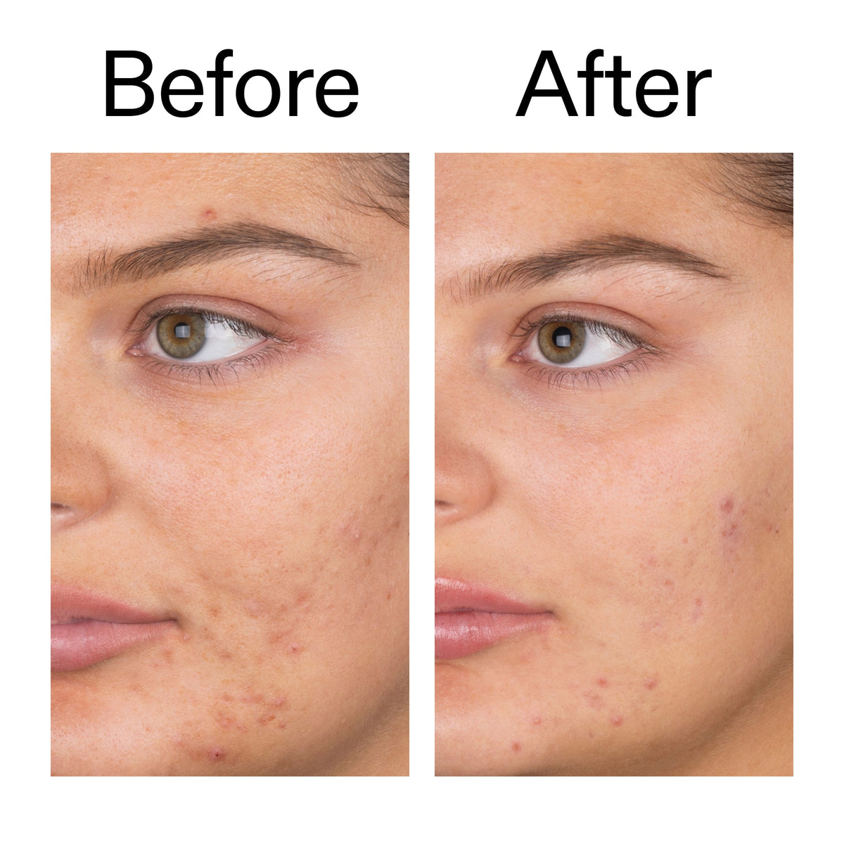 salicylic-acid-cleanser-duo-q9 Salicylic_Acid_Cleanser_-_150ml_Before_After_2000x2000_e7230494-853f-4b07-82b1-27669104c995.jpg