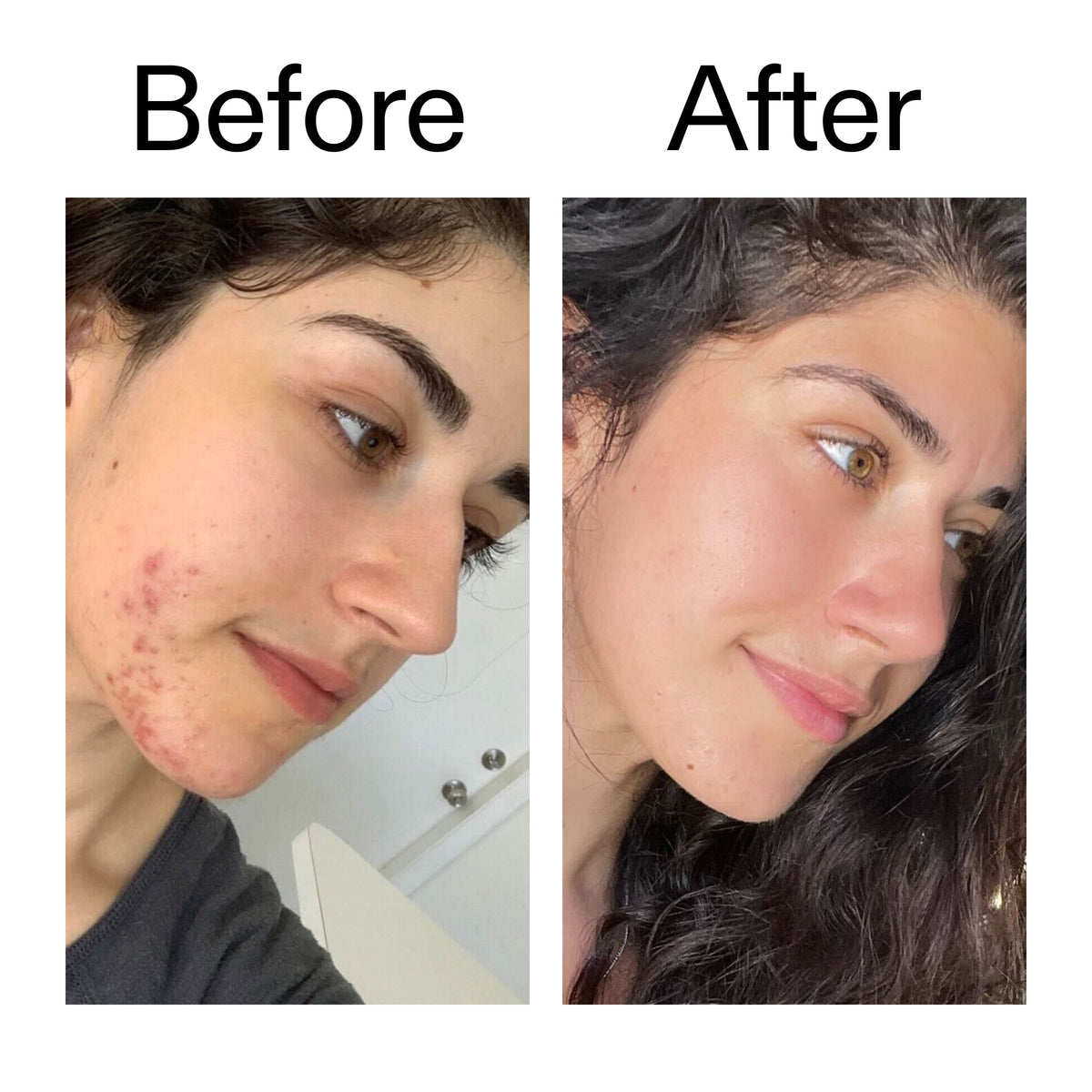 succinic-acid-acne-treatment-r4 Succinic_Acid_Treatment_Before_After_2000x2000_6a5f0054-2f58-4433-9314-0dc72c9bdd3b.jpg