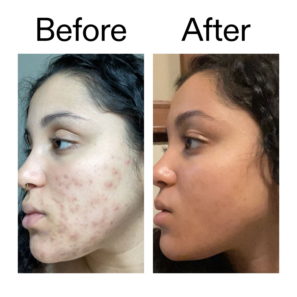 tranexamic-acid-serum-f9 Tranexamic_Acid_Serum_Before_After_2000x2000_98ebc8be-77b0-4843-8a22-90790ebe918b.jpg